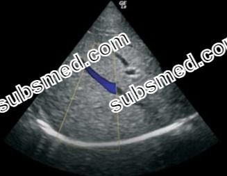 GE 3S-RS Cardiac Ultrasound Probe Scanner Head Crystal